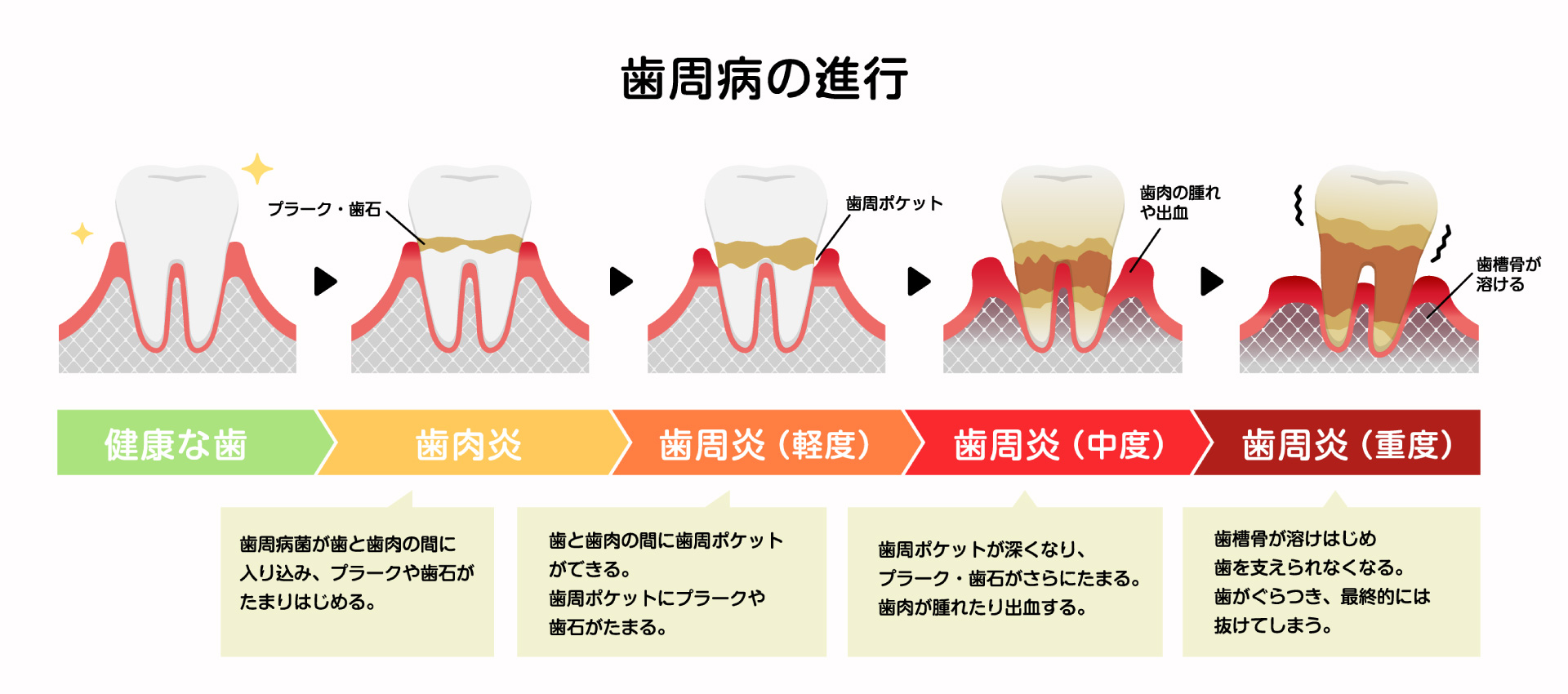 歯周病の進行と症状
