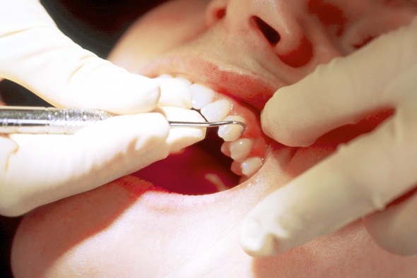 スケーリング（歯石除去）